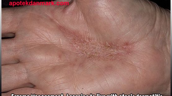 Vad är skillnaden mellan eksem och psoriasis? Märkbara skillnader