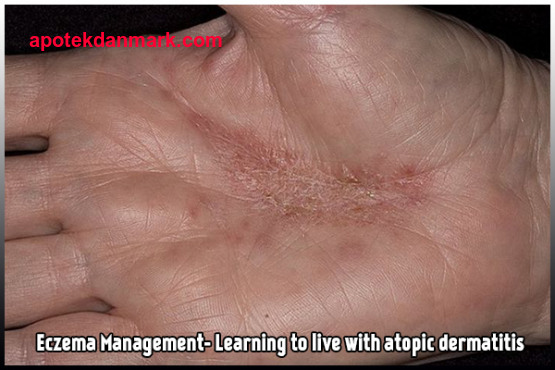 At leve med dermatitis i Missouri