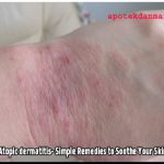 Det senaste inom hudvård för din atopisk dermatit tillhandahålls av riktiga hudläkare