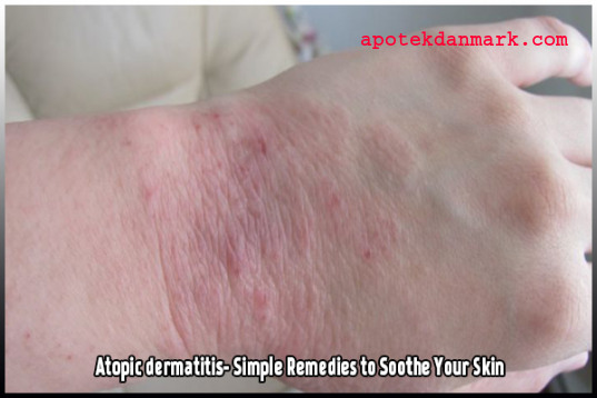 At leve med dermatitis og stress