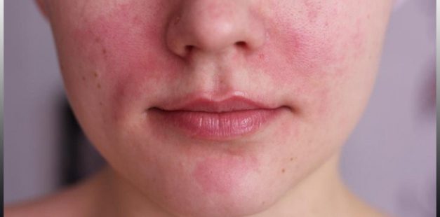Det senaste inom hudvård för din atopisk dermatit tillhandahålls av riktiga hudläkare