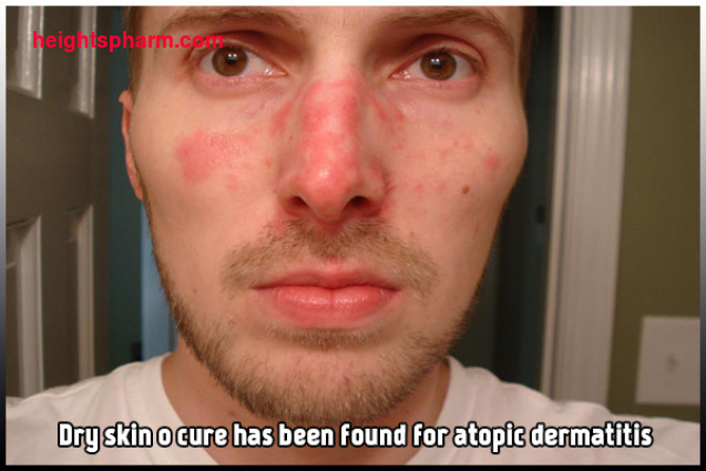 Att Leva Med Dermatit Och Katter