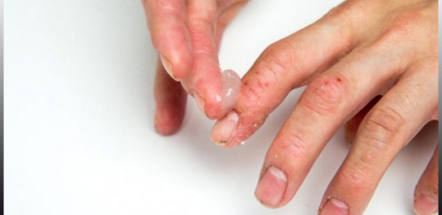 Atopisk dermatit - Gemenskap hos barn men kan förekomma i alla åldrar